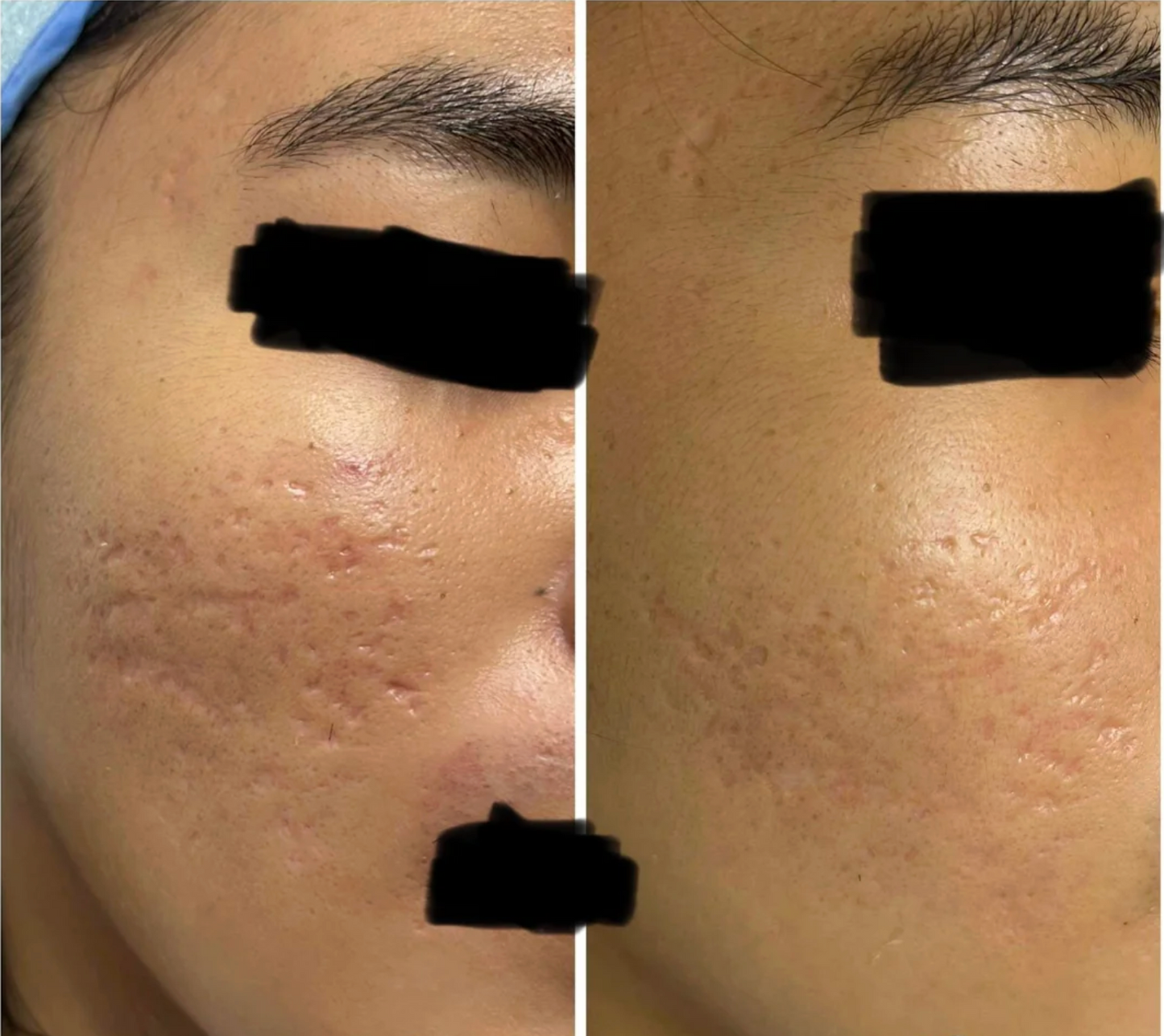 Medical Grade ScarFade Silicone Stick ™