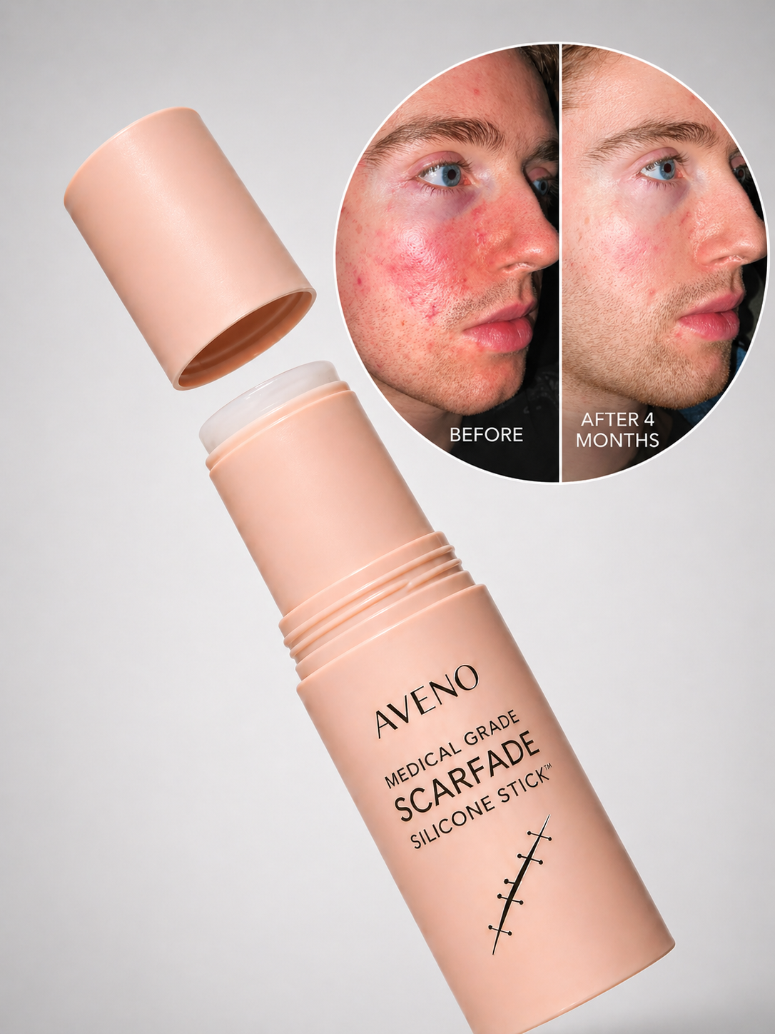 Medical Grade ScarFade Silicone Stick ™